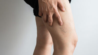 اعراض جلطة الساق وأسبابها وعلاجها والوقاية منها