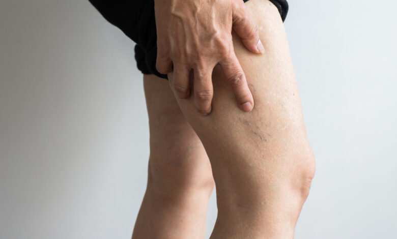 اعراض جلطة الساق وأسبابها وعلاجها والوقاية منها
