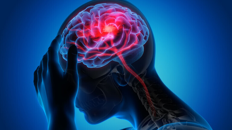 خبراء يذكرون علامات "غير عادية" للسكتة الدماغية قد لا نكون على دراية بها