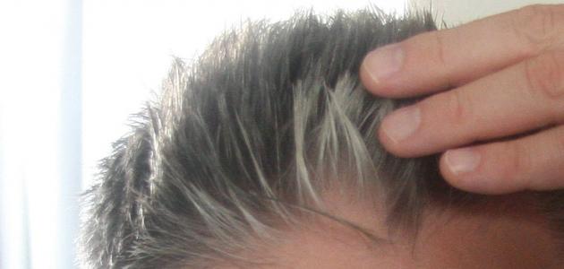 هل هناك علاج حقيقي لشيب الشعر؟.. إليك الإجابة